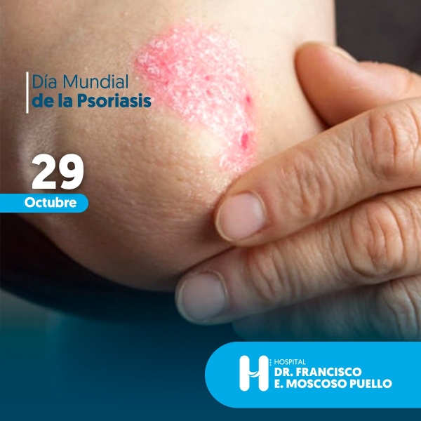 Dermatóloga del Moscoso Puello recomienda a pacientes psoriasis seguir tratamiento